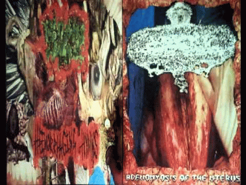Urinary Tract Infection From Severe Pus Clots : Split Tape 2010